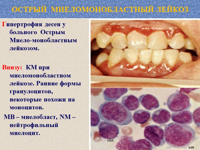 ОСТРЫЙ  МИЕЛОМОНОБЛАСТНЫЙ ЛЕЙКОЗ Гипертрофия десен у больного  Острым Миело-монобластным лейкозом.  Внизу: